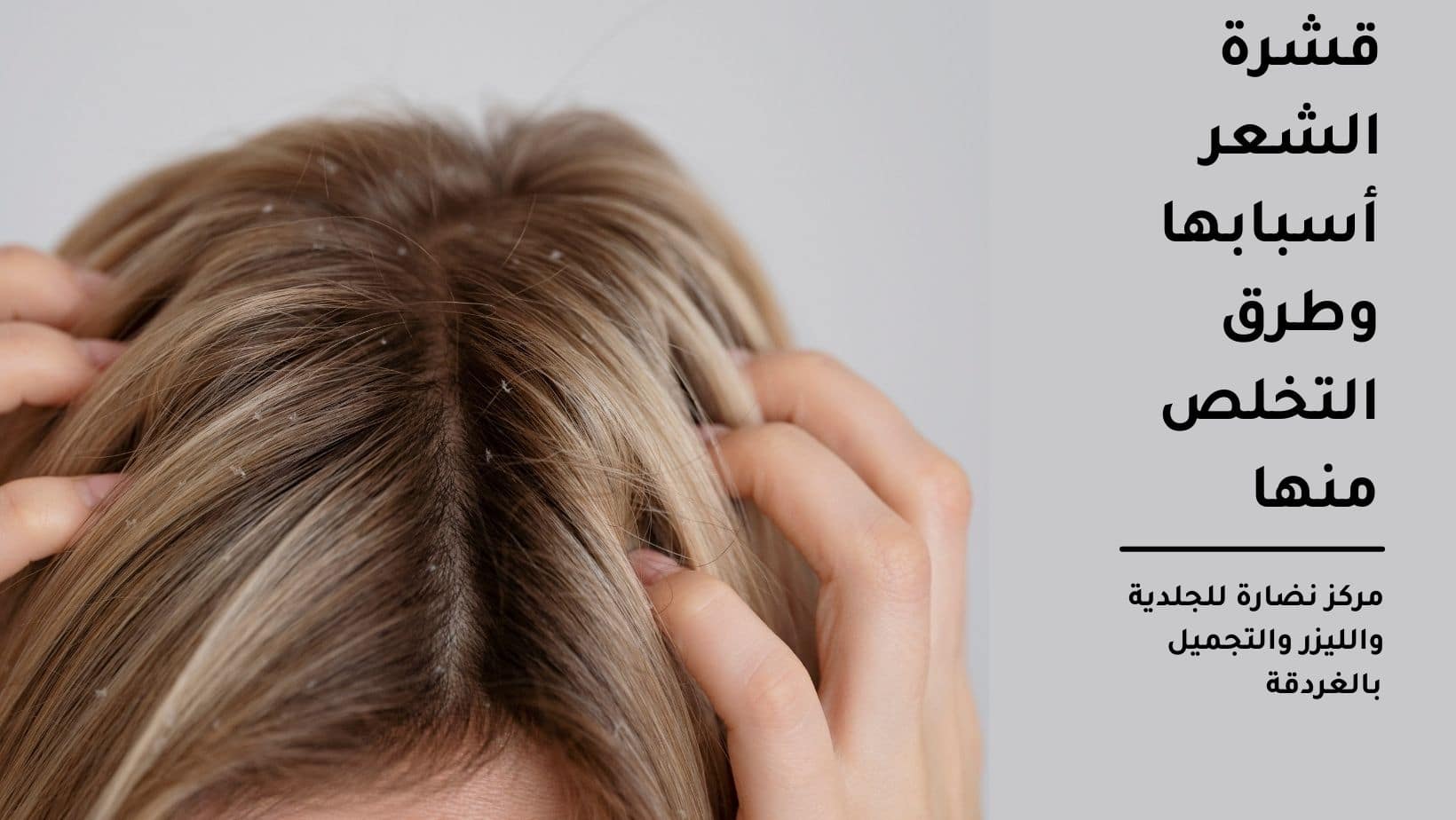 قشرة الشعر أسبابها وطرق التخلص منها